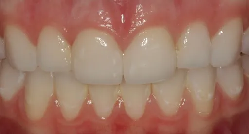 close-up of crown on front teeth