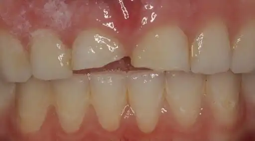 close-up of front broken teeth