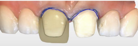 Dental 3D Design