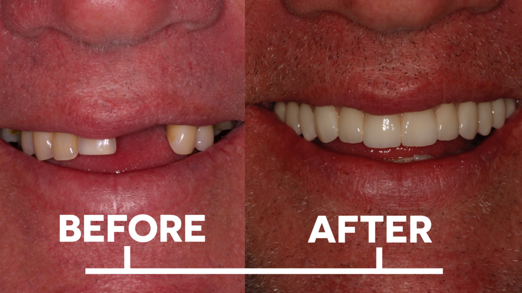 a collage of teeth and mouth before and after