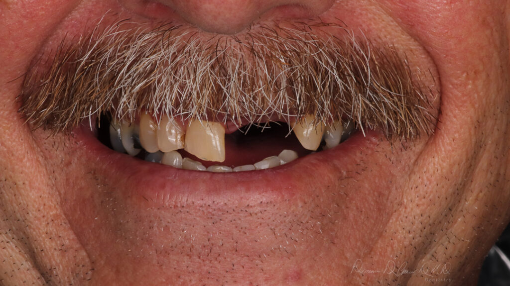 Maintenance after dental implants