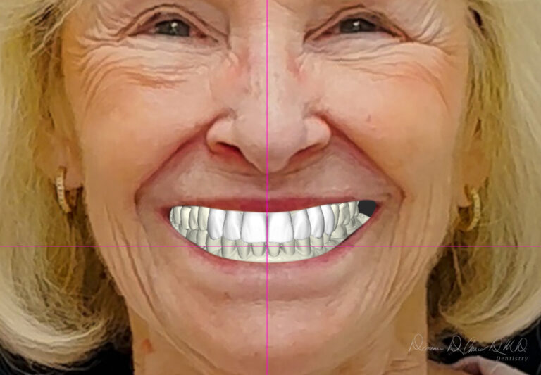 Digital Smile Design model