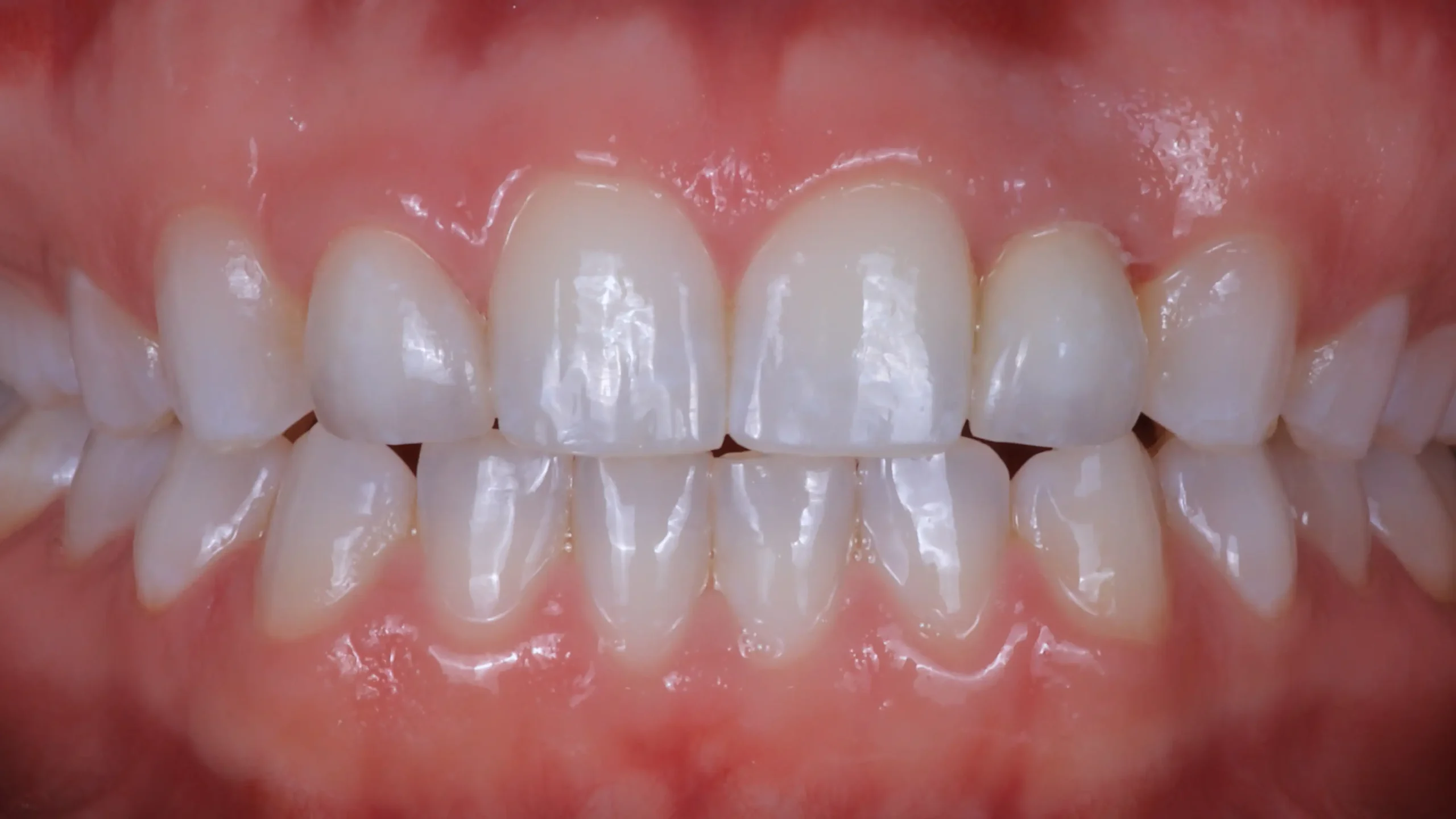 2 after.webp after ultra-thin veneers