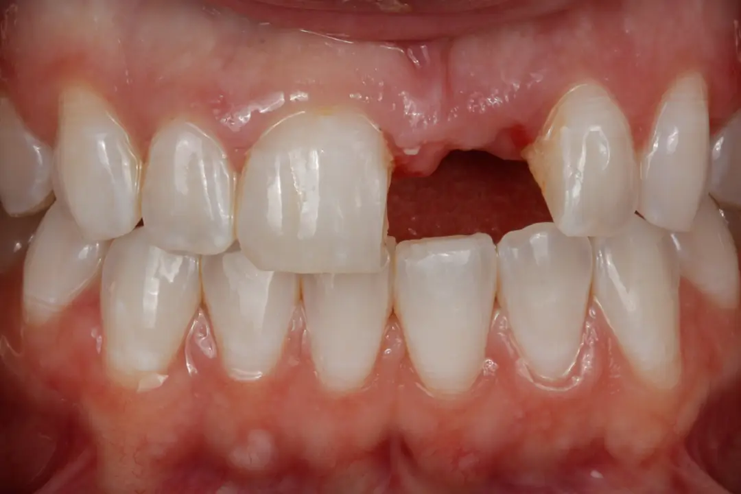 before Dental Implant for front tooth
