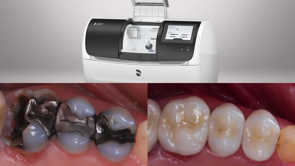 CEREC Crowns