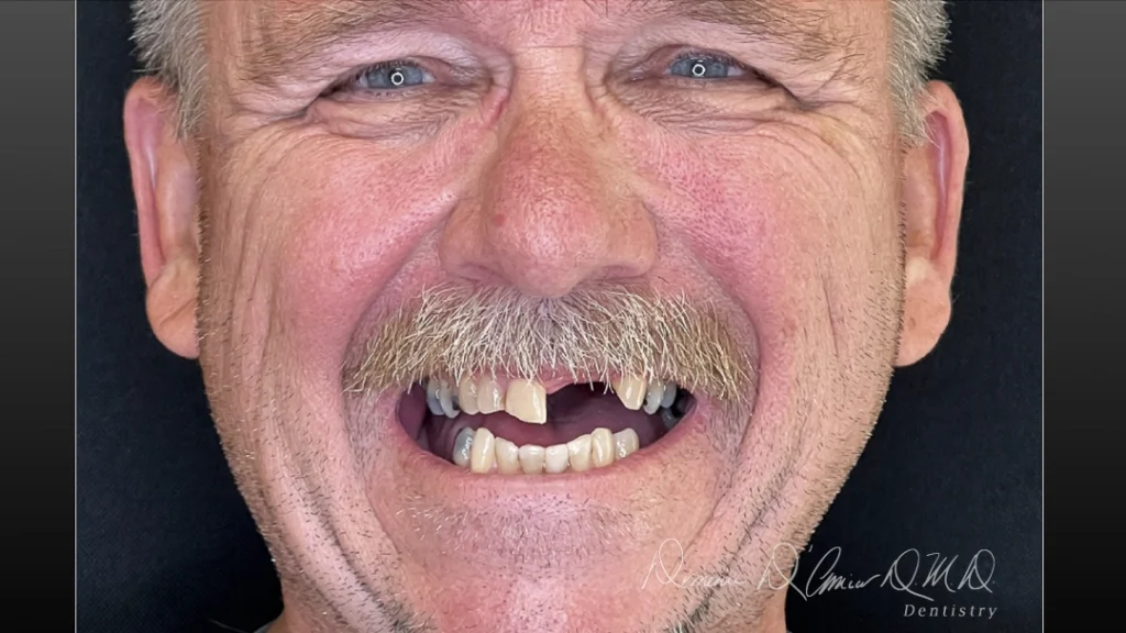 patient for porcelain veneers