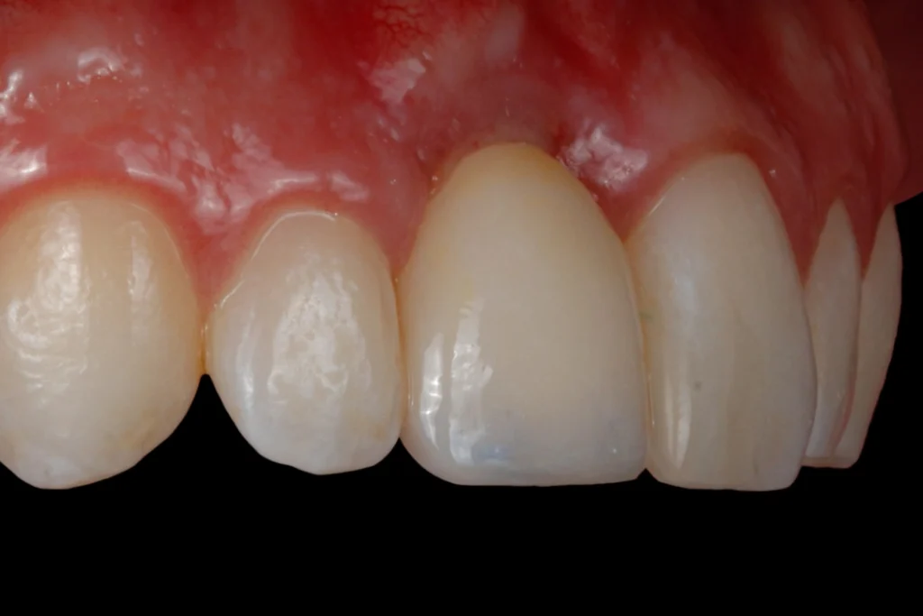 after Dental Implant Placement