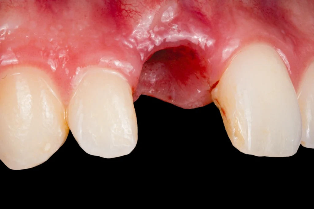 before Dental Implant Placement
