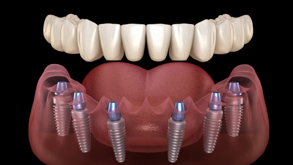 All-on-4 Dental Implants