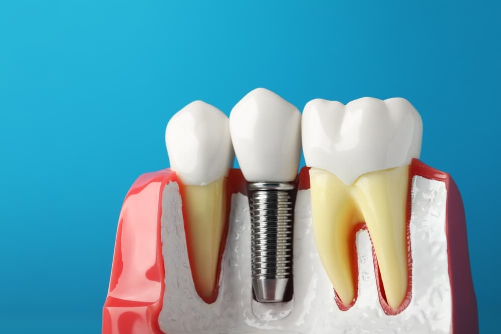 What Are Dental Implants?
