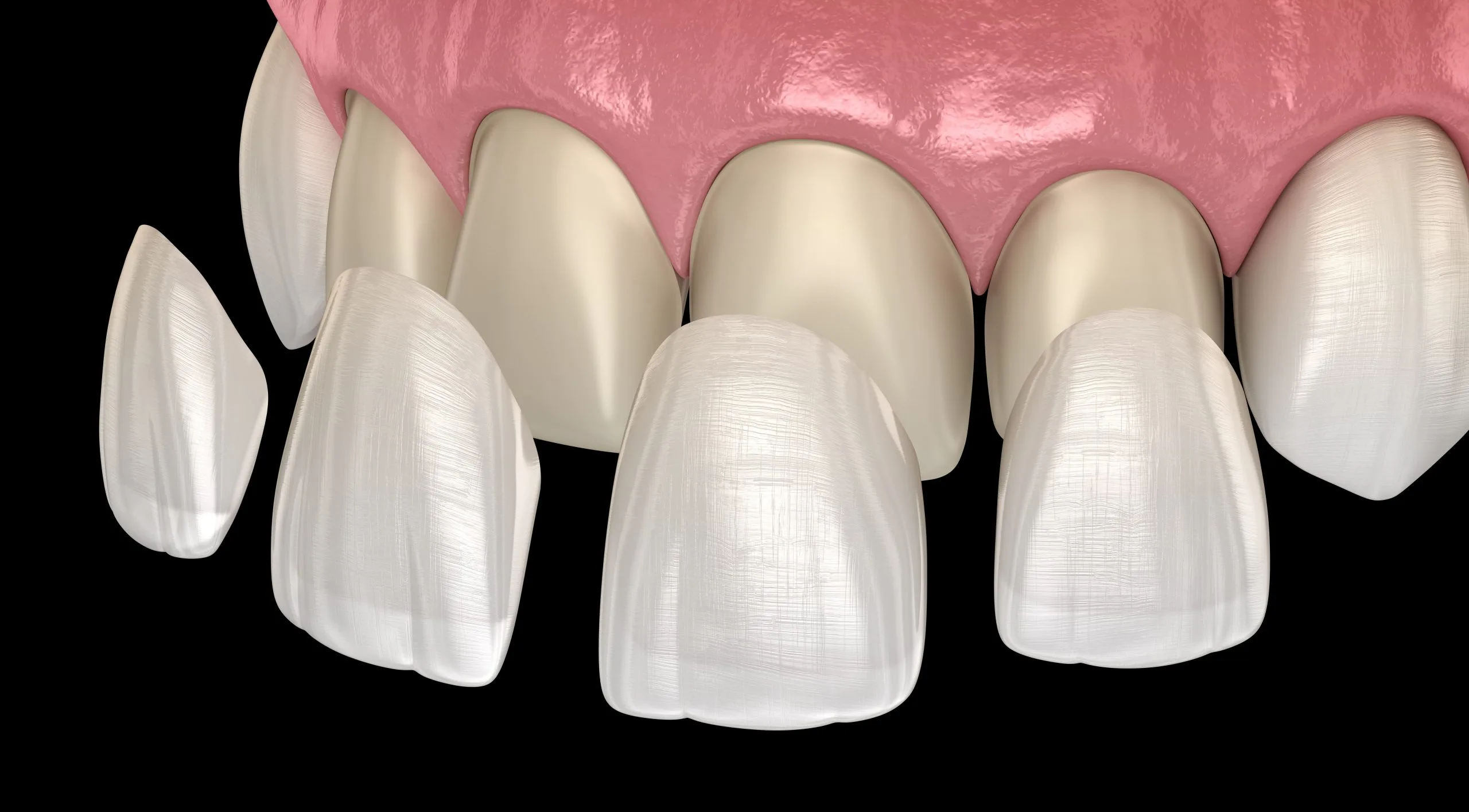 Veneer placement