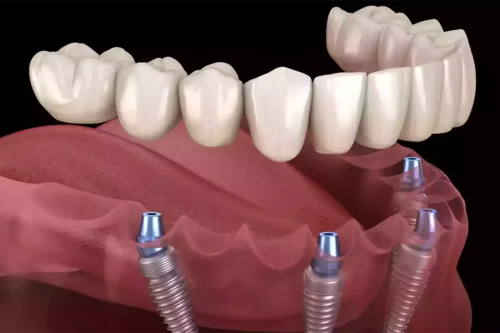 digital image of All-on-4 Implants