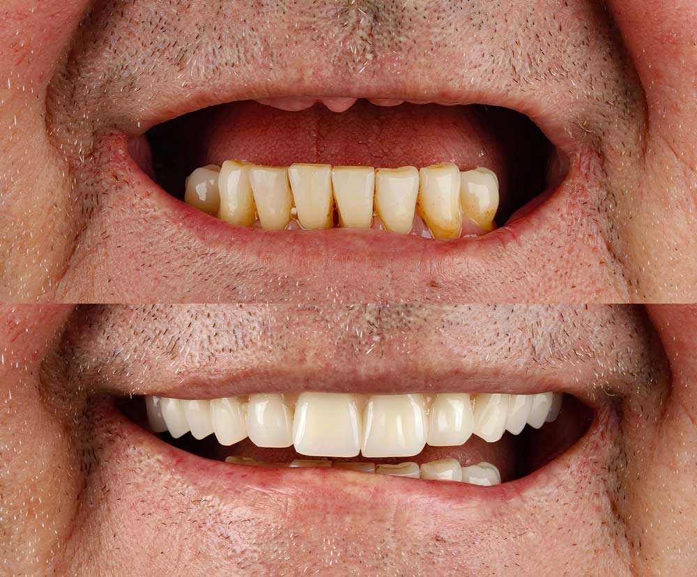 All-on-4-Implants before & after