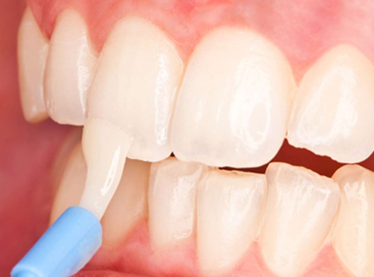 Fluoride Treatment in family dentistry