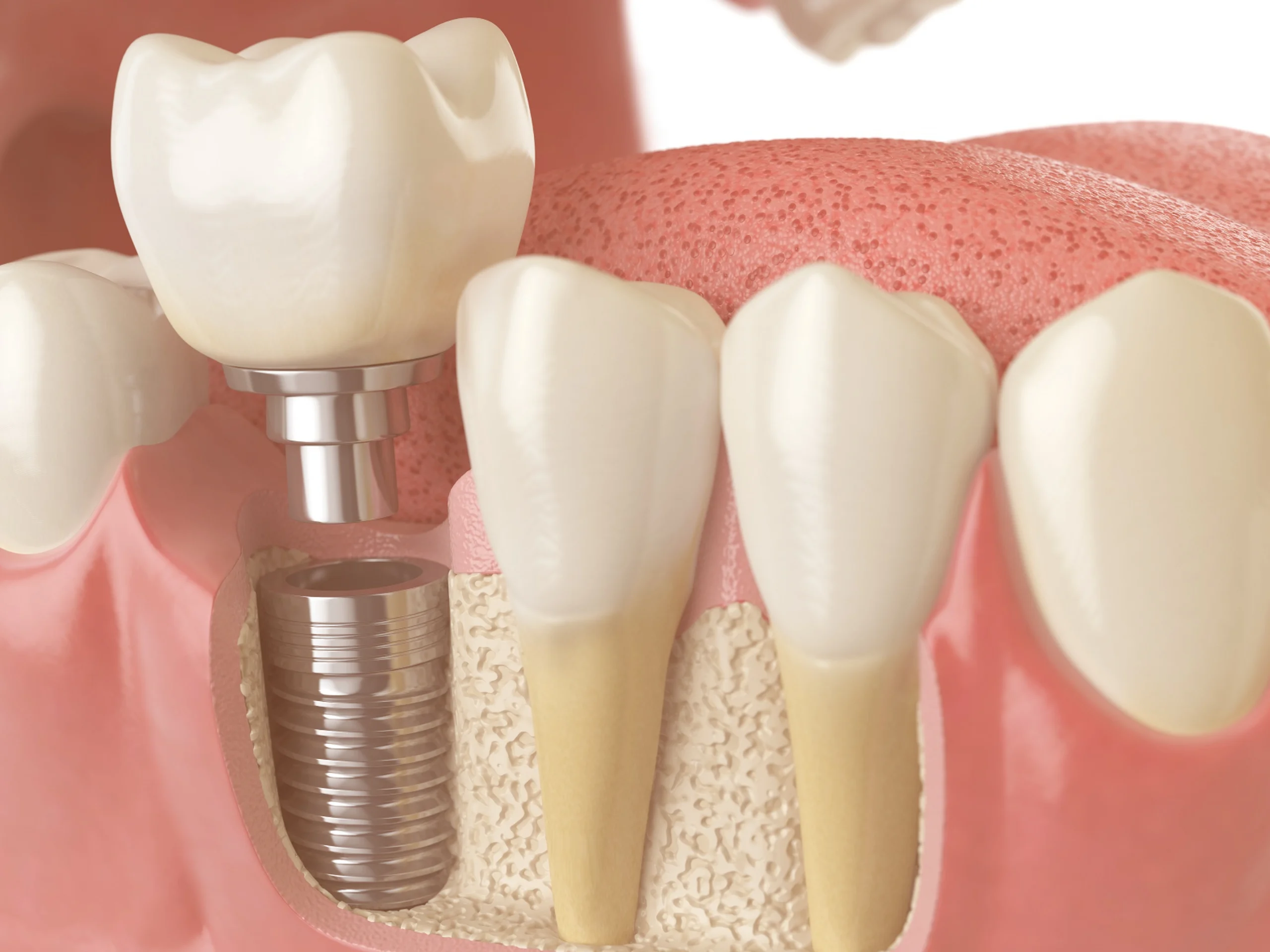 Bone Grafting for Dental Implants