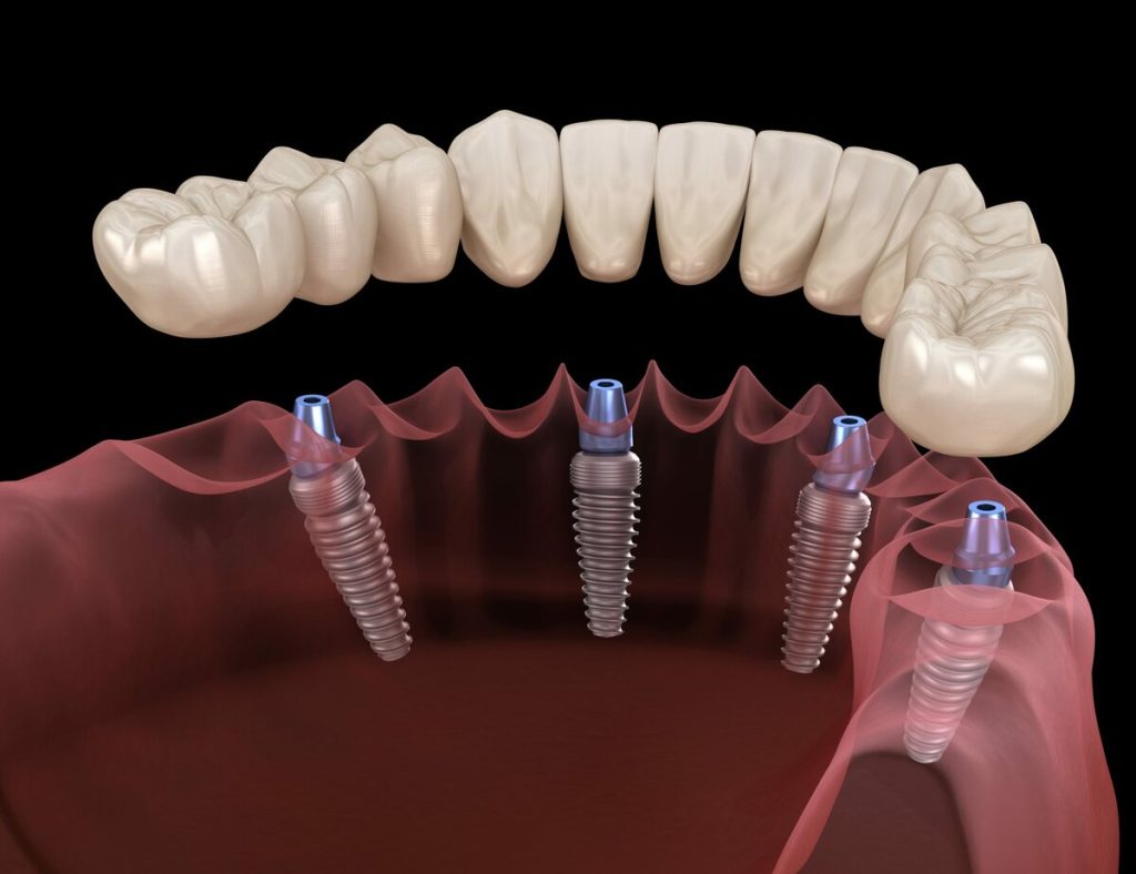 all-on-four implant