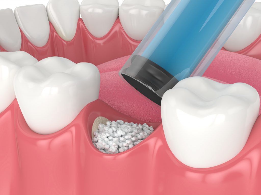 Factors Affecting Bone graft Success Rates
