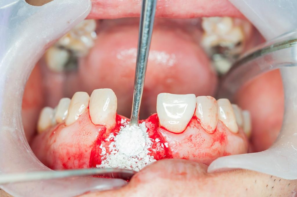 Allografts (Donor Bone)