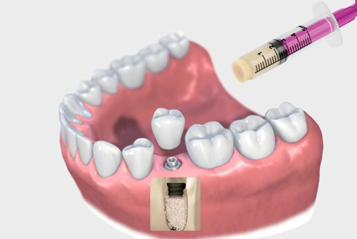 Autografts (Self-donated Bone)