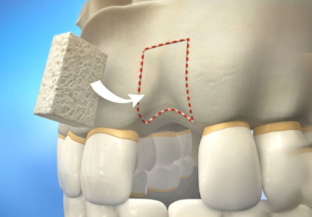 Alloplastic grafts