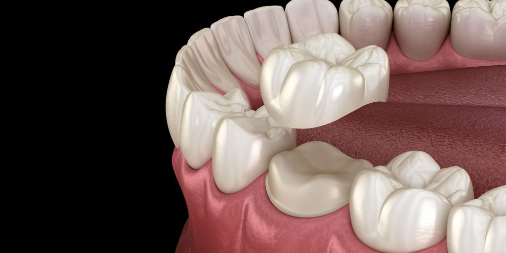 cerec crowns on tooth