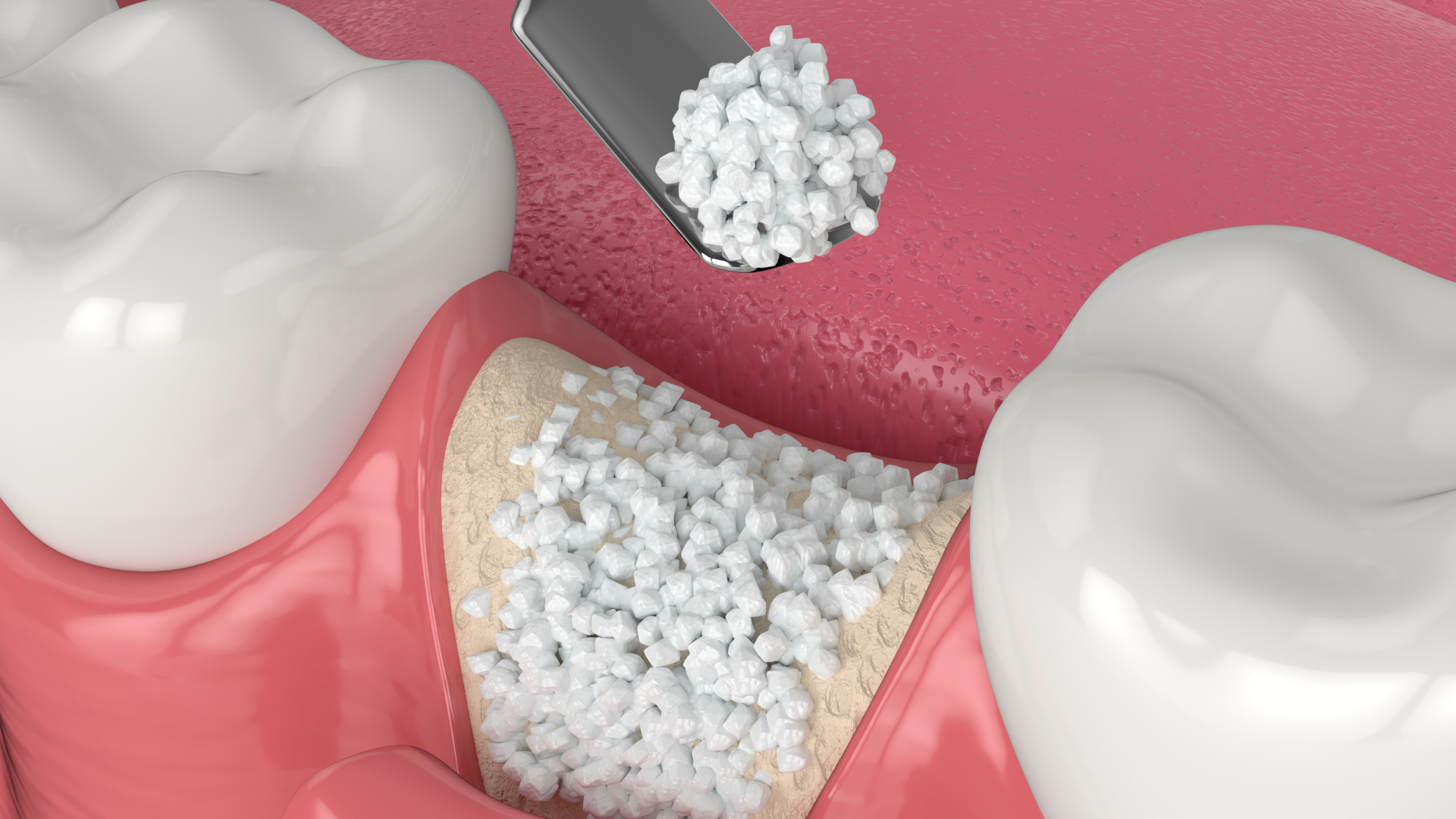 Dental bone grafting