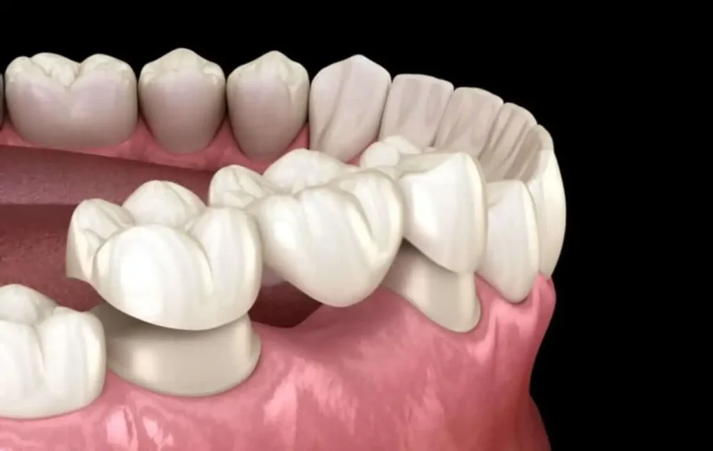 a close-up of a teeth covered by crowns