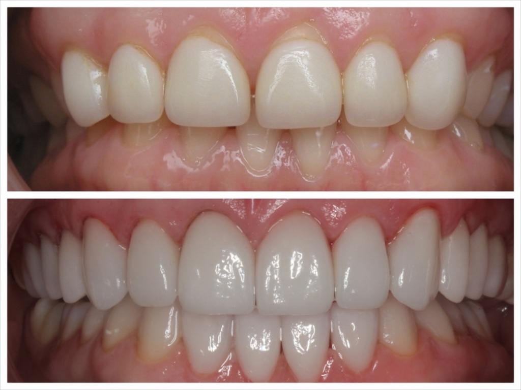 dental porcelain veneers before after