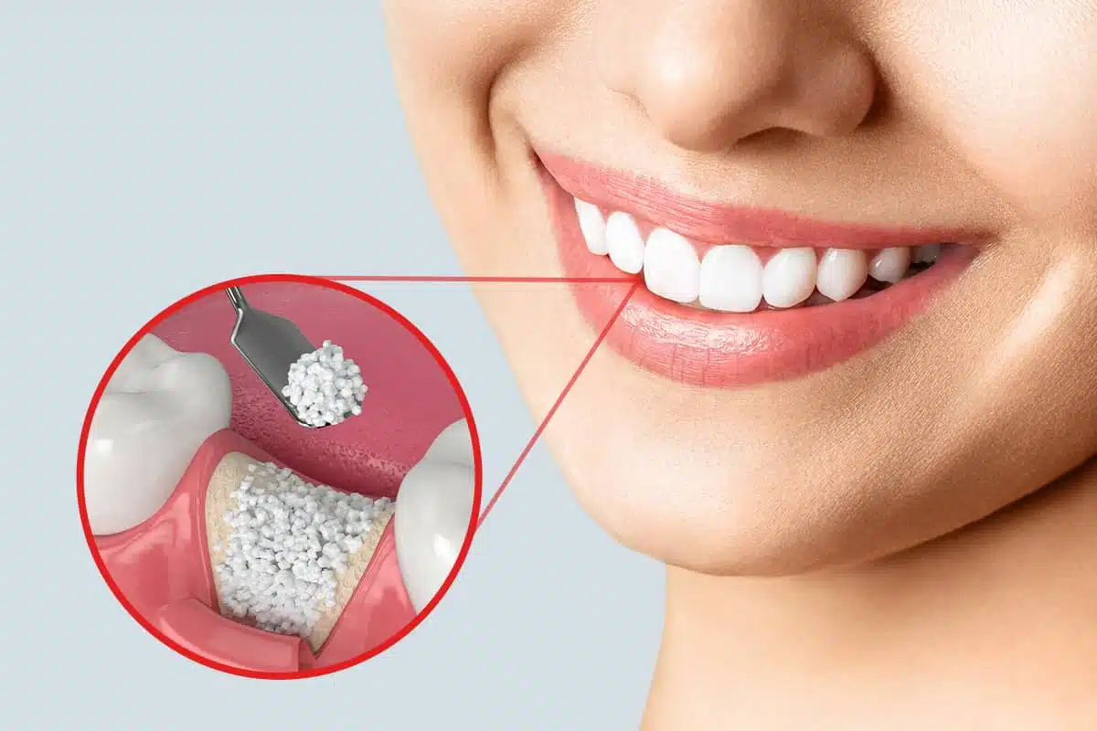 Bone Grafting Success Rates