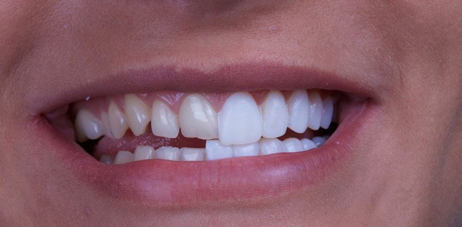 ceramic veneers