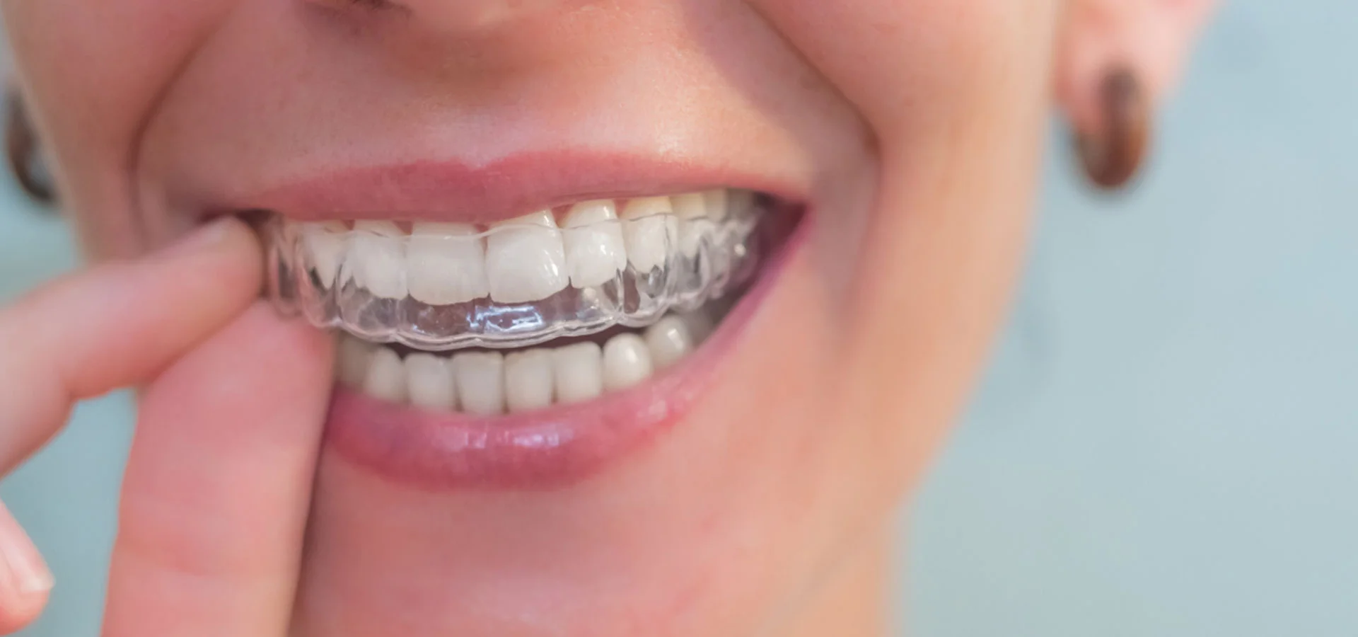 Custom Plan for SureSmile Treatment