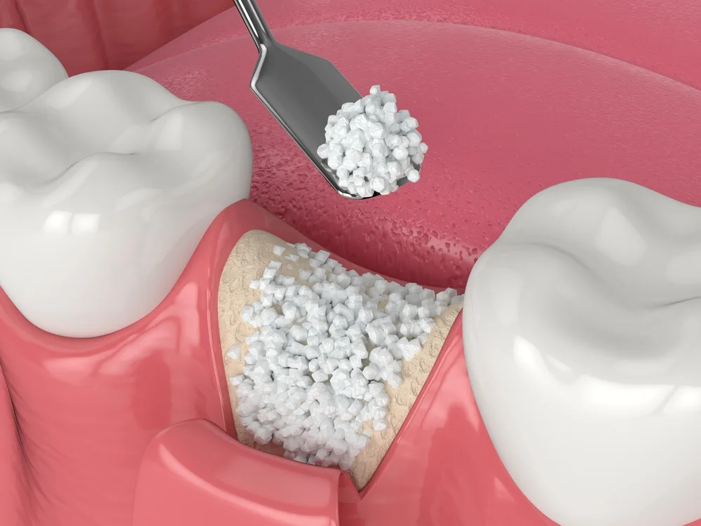 Bone grafting for dental implants