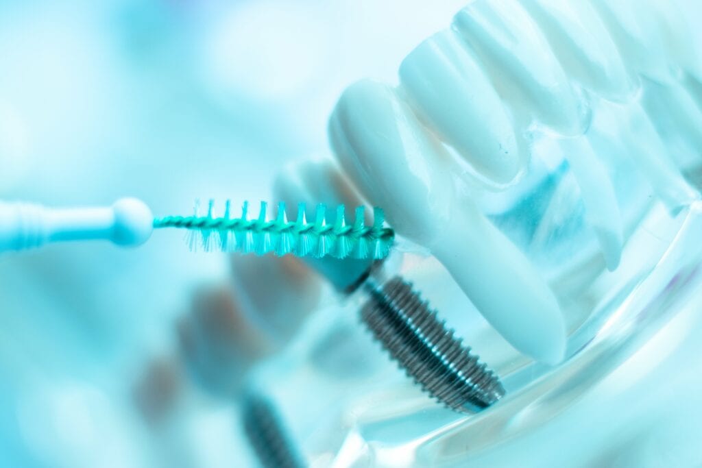 Brushing and Flossing Around Implants