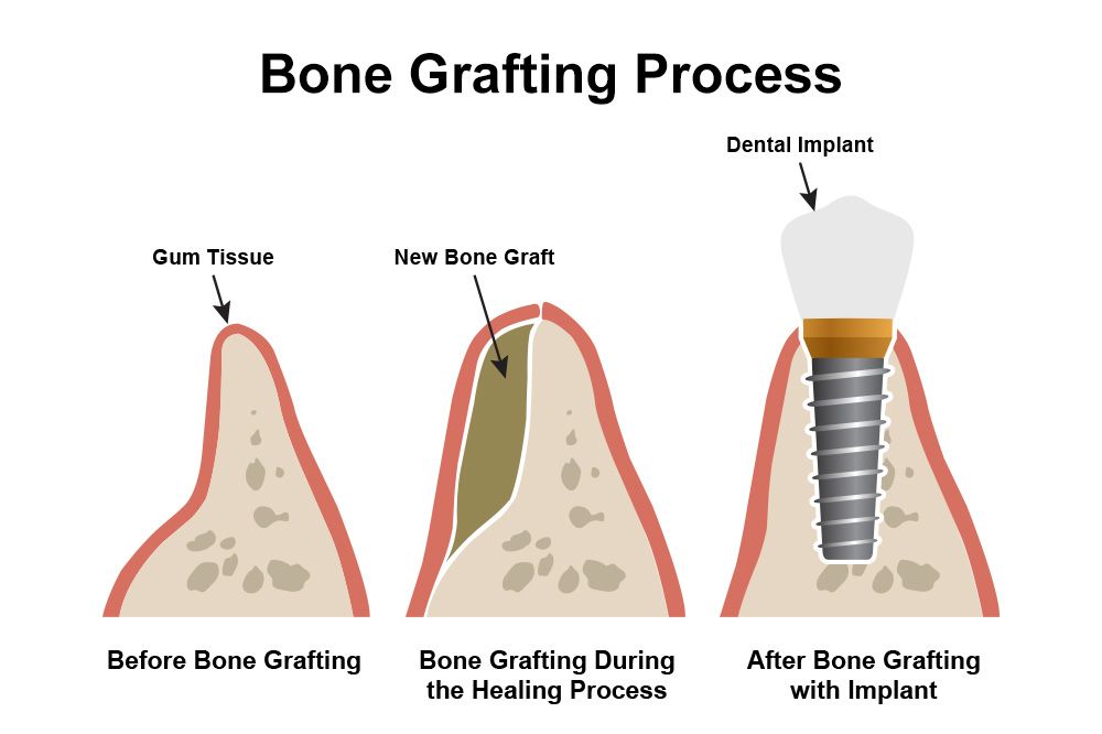The Bone Grafting Procedure 