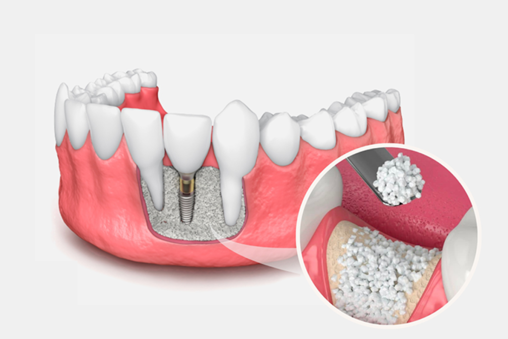 The Impact of Bone Grafting on Implant Success