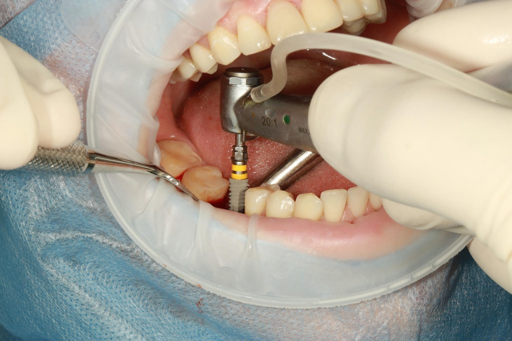 The Surgical Process of Dental Implants