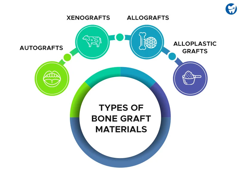 Types of Bone Grafts Used in Implant Surgery