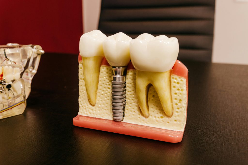 Dental Implant Procedure