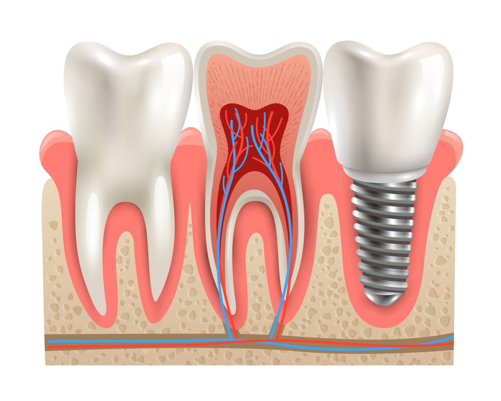 Dental Implant Risks and Complication