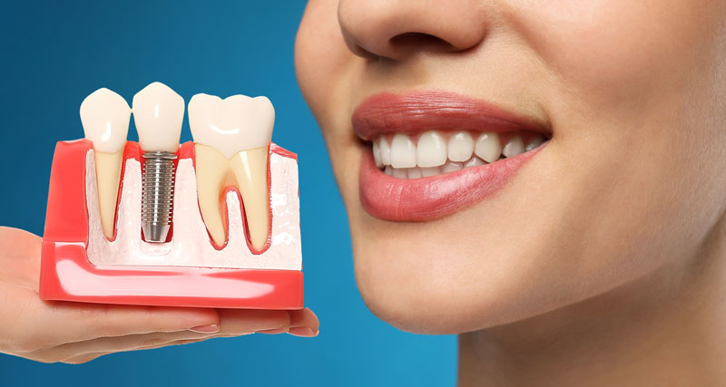 5 Benefits of Dental Implants